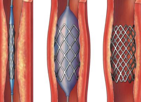 好消息！700元冠脈支架來(lái)了帶量采購(gòu)結(jié)果在甘肅省正式落地執(zhí)行